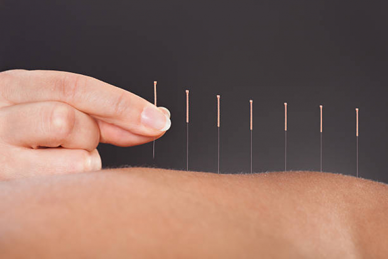 Acupuntura para Coluna Clínica Chácara Klabin - Acupuntura para Nervo Ciático