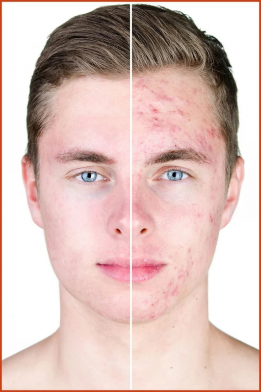 Clínica com Peeling para Acne Praça Da Árvore - Peeling para Poros Dilatados