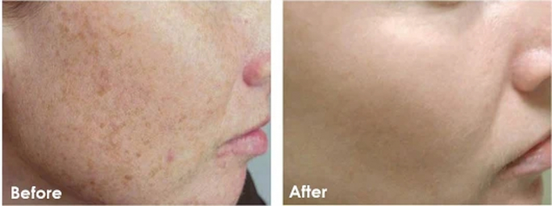 Clínica com Peeling para Cicatrizes Vila Mariana - Peeling para Clarear Virilha