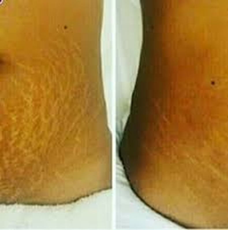 Clínica de Estética para Tirar Estrias Consolação - Clínica de Estética para Secar Vasinhos