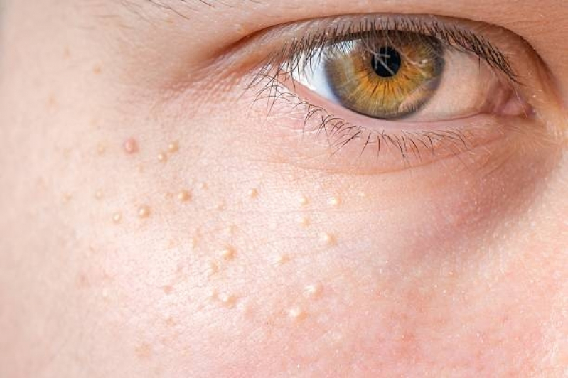 Clínica de Tratamento de Pele para Milium Vila Mariana - Tratamento para Tirar Manchas da Pele