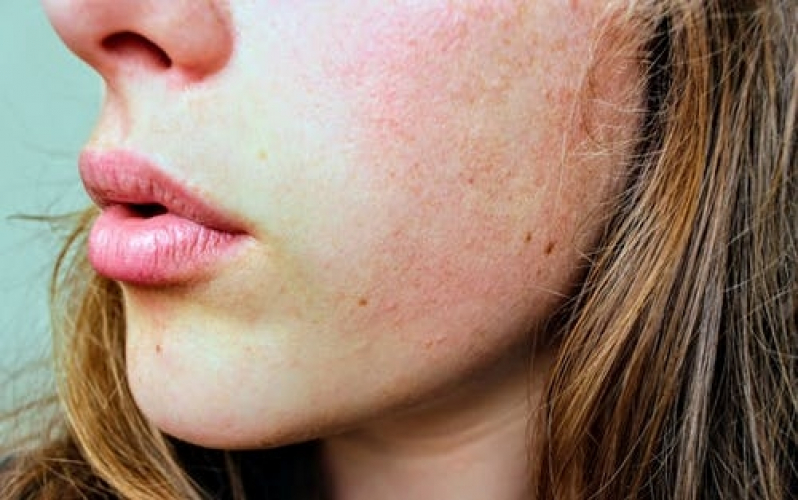 Clínica de Tratamento para Manchas na Pele Consolação - Tratamento para Os Poros da Pele