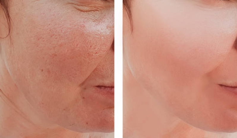 Clínica de Tratamento para Os Poros da Pele Chácara Klabin - Tratamento de Pele para Milium