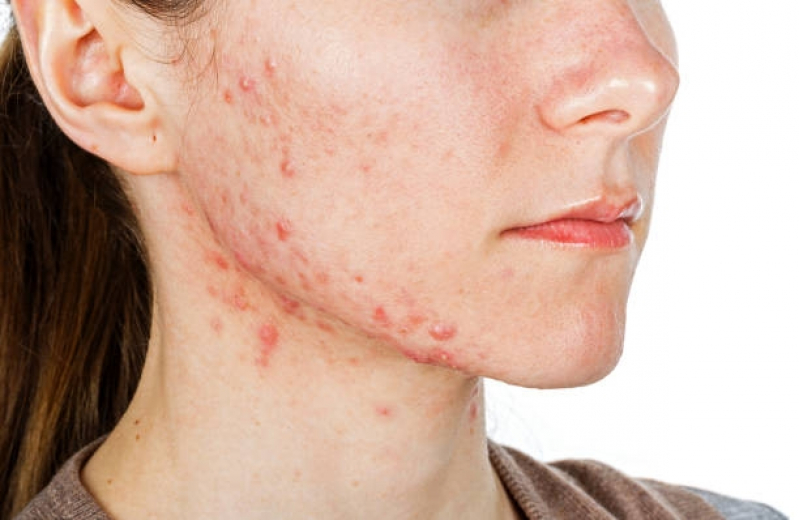 Clínica para Tratamento a Laser para Acne Praça Da Árvore - Tratamento para Acne Hormonal