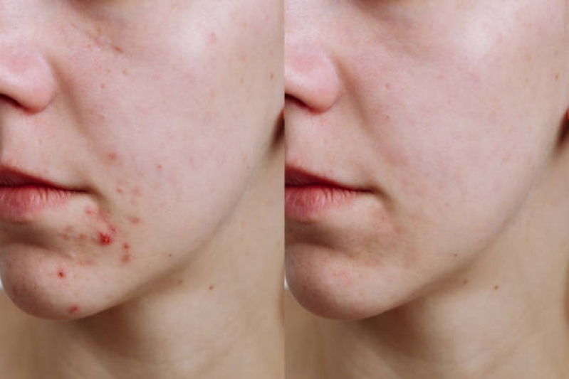 Clínica para Tratamento Acne Comprimidos Bela Cintra - Tratamento a Laser para Acne