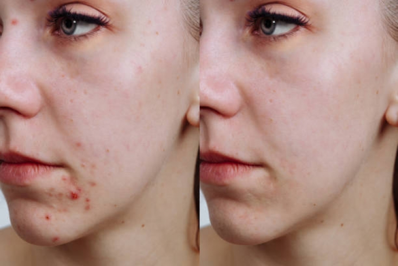 Clínica para Tratamento Acne Chácara Klabin - Tratamento para Cicatriz de Acne