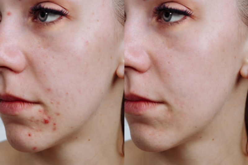 Clínica para Tratamento Acne Vila Madalena - Tratamento Acne