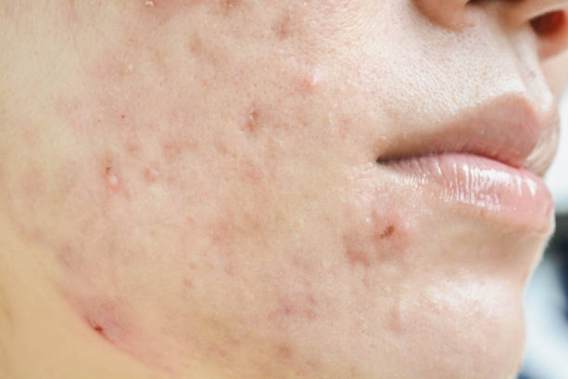 Clínica para Tratamento para Acne e Manchas Consolação - Tratamento contra Acne