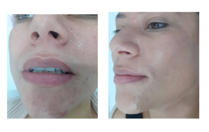 Clínica para Tratamento para Acne Hormonal Consolação - Tratamento para Marcas de Acne