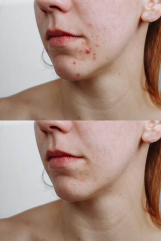 Clínica para Tratamento para Cicatriz de Acne Ana Rosa - Tratamento para Marcas de Acne