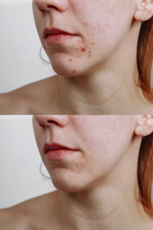 Clínica para Tratamento para Cicatriz de Acne Consolação - Tratamento para Acne e Manchas