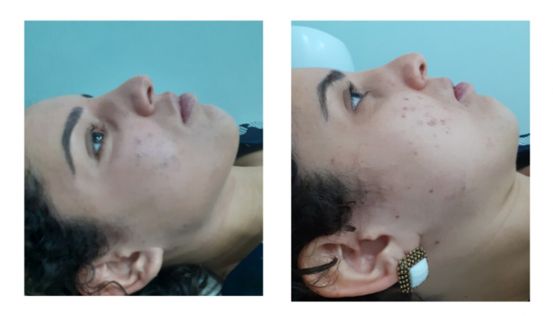 Clínica para Tratamento para Manchas de Acne Chácara Klabin - Tratamento de Acne