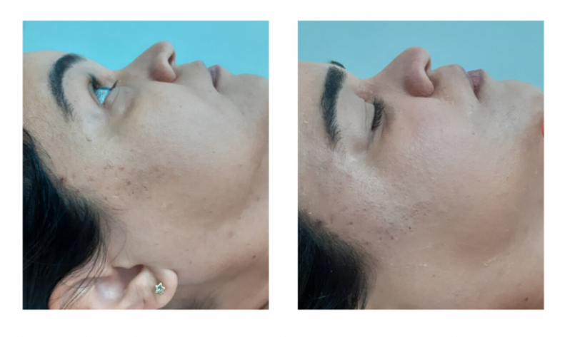 Clínica para Tratamento para Marcas de Acne Praça Da Árvore - Tratamento para Acne Hormonal