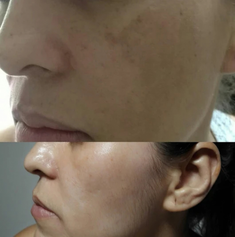 Clínicas de Estética para Tirar Manchas da Pele Consolação - Clínica de Estética Tratamento para Celulite