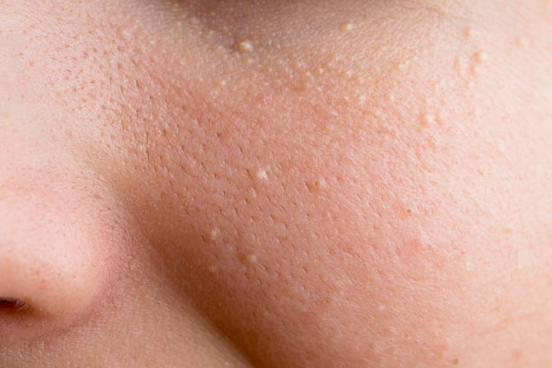 Fazer Tratamento de Pele para Milium Vila Madalena - Tratamento para Os Poros da Pele