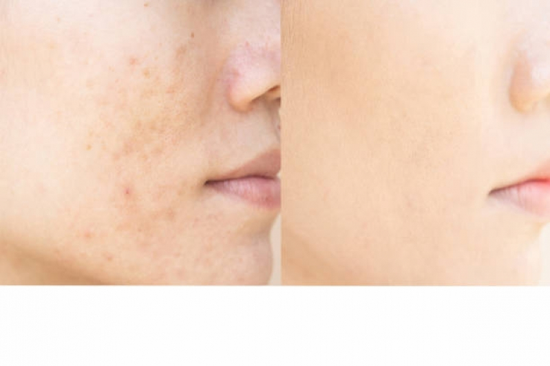 Fazer Tratamento para Manchas na Pele Vila Mariana - Tratamento para Os Poros da Pele
