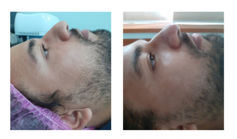 Fazer Tratamento para Os Poros da Pele Ana Rosa - Tratamento Pele Oleosa