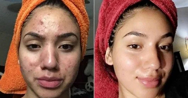 Limpeza de Pele Acne Saúde - Limpeza de Pele Cravos