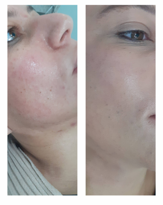 Limpeza de Pele com Acne Valor Saúde - Limpeza de Pele Facial