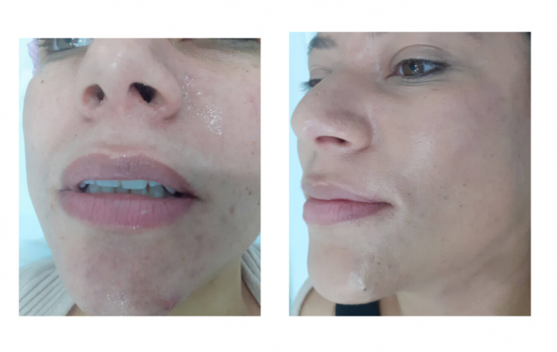 Limpeza de Pele com Acne Ana Rosa - Limpeza de Pele Facial