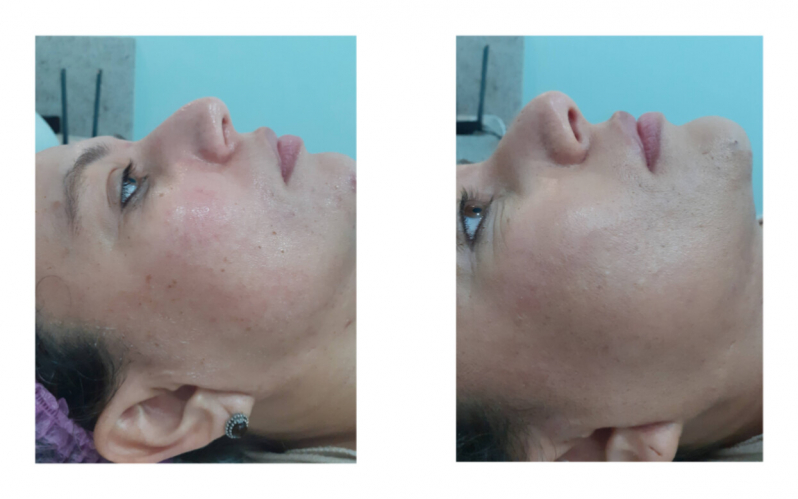 Limpeza de Pele com Aplicação de Vitamina Preços Vila Madalena - Limpeza de Pele com Acne