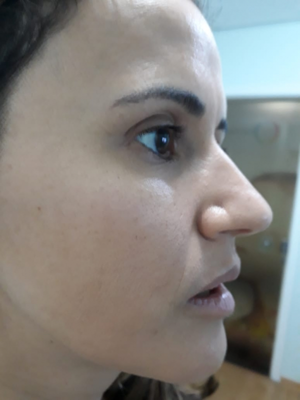 Limpeza de Pele com Extração Preço Bela Cintra - Limpeza de Pele Acne