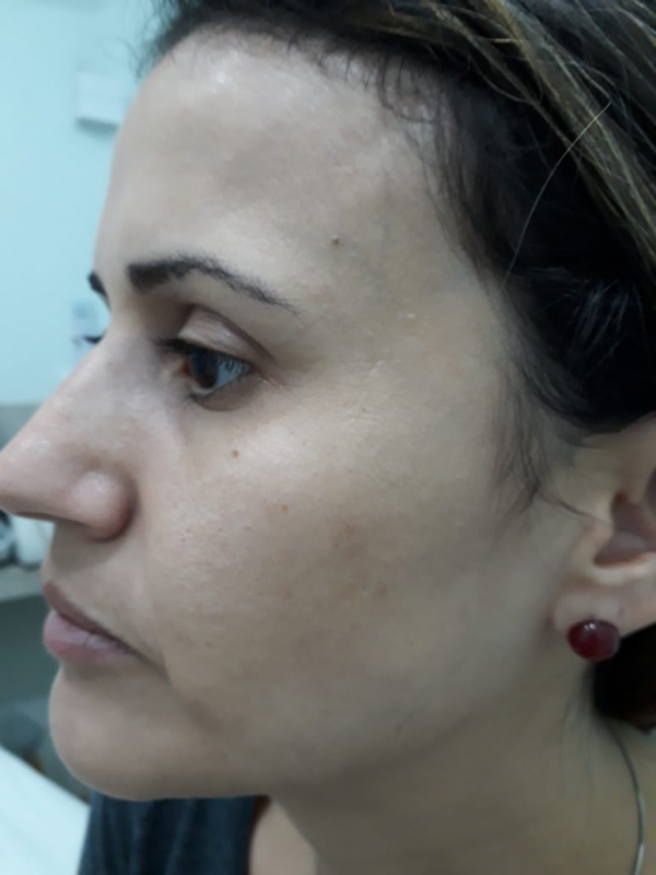 Limpeza de Pele com Extração Vila Madalena - Limpeza de Pele Acne