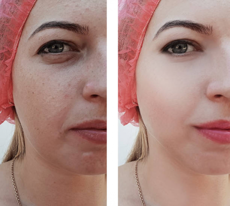 Limpeza de Pele Costas Preços Ana Rosa - Limpeza de Pele Facial