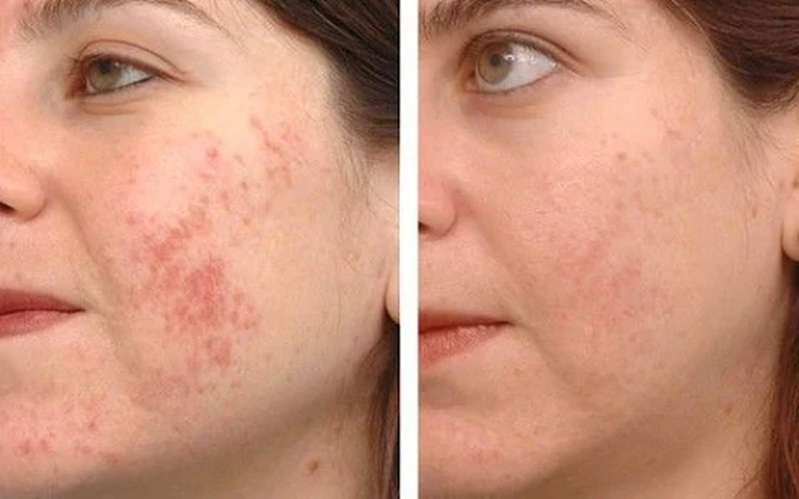 Limpeza de Pele Cravos Preço Saúde - Limpeza de Pele Acne