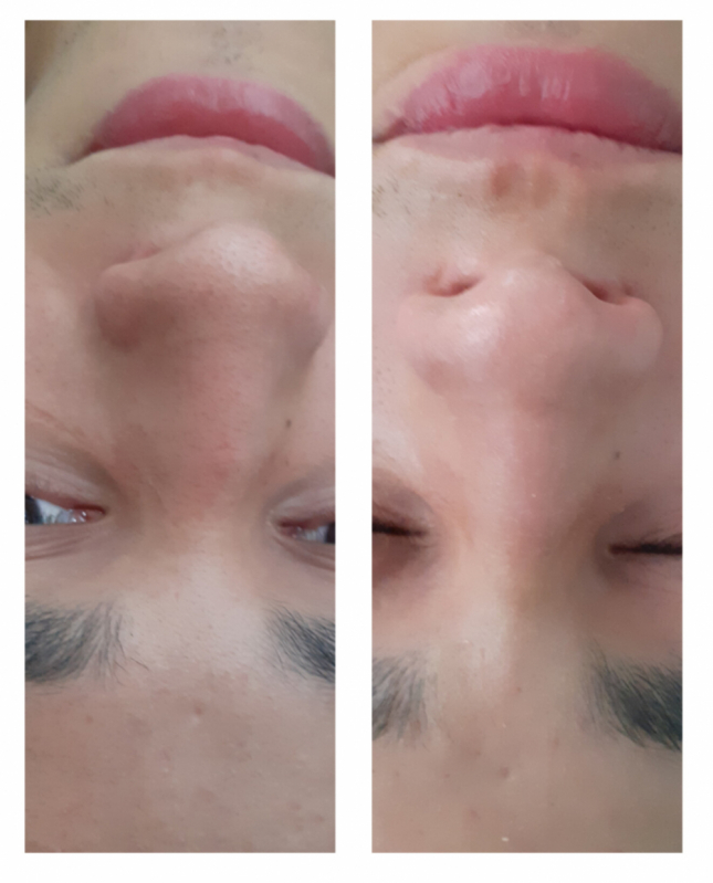 Limpeza de Pele Facial Preços Consolação - Limpeza de Pele para Cicatrizes de Acne