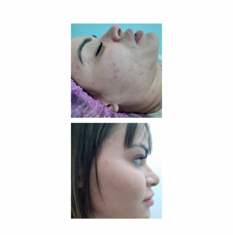 Limpeza de Pele Facial Valor Saúde - Limpeza de Pele com Acne