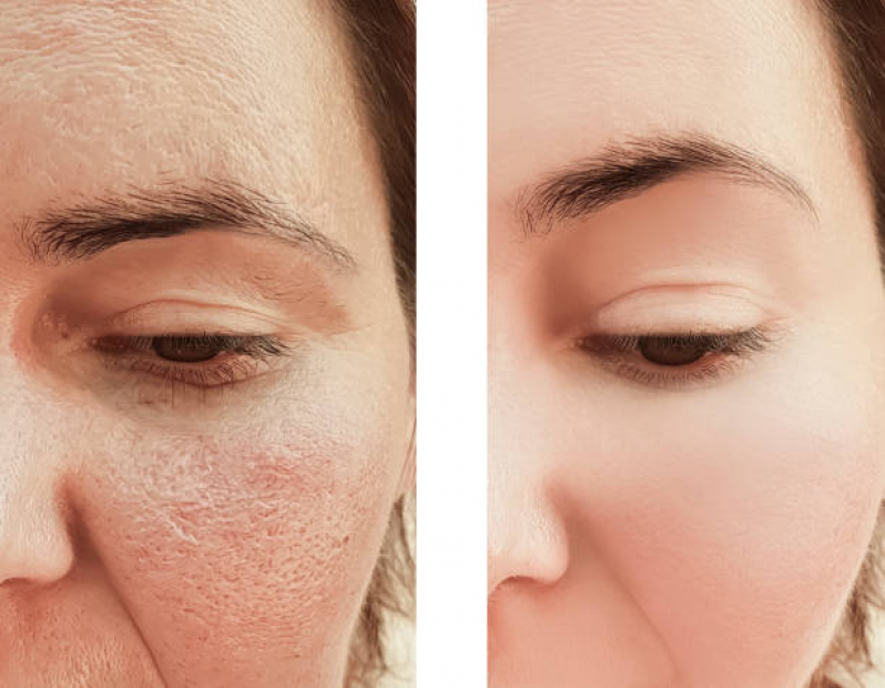 Limpeza de Pele para Cicatrizes de Acne Valor Praça Da Árvore - Limpeza de Pele Facial