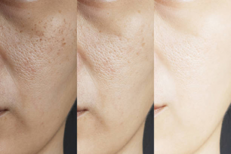 Limpeza de Pele para Cicatrizes de Acne Higienópolis - Limpeza de Pele com Aplicação de Vitamina