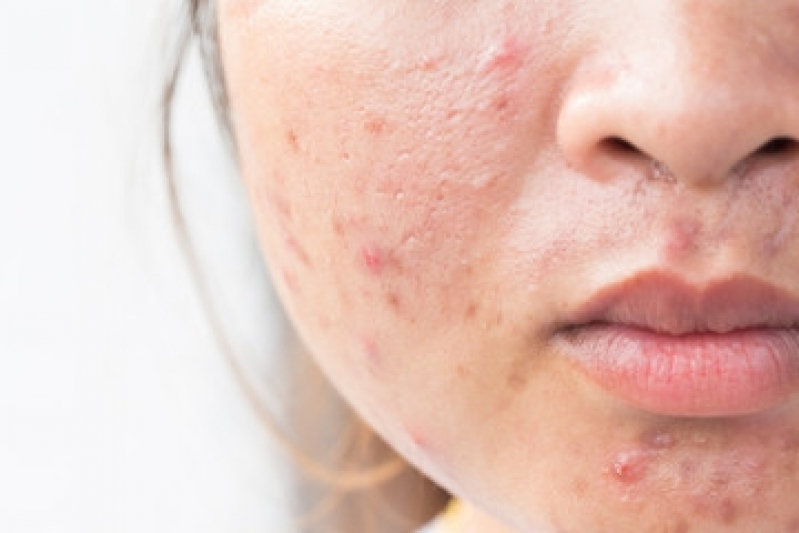 Limpeza de Pele para Espinhas Consolação - Limpeza de Pele Acne