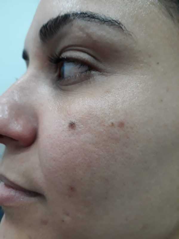 Limpeza de Pele para Tirar Manchas Saúde - Limpeza de Pele Dermatologista