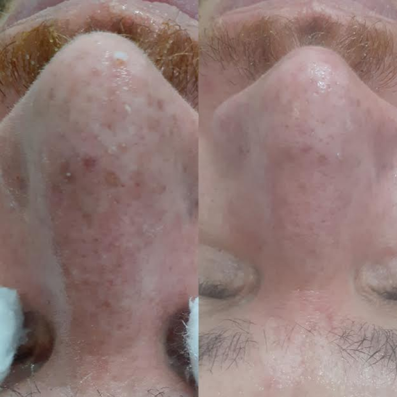 Limpeza de Pele Profissional Valor Consolação - Limpeza de Pele para Cicatrizes de Acne