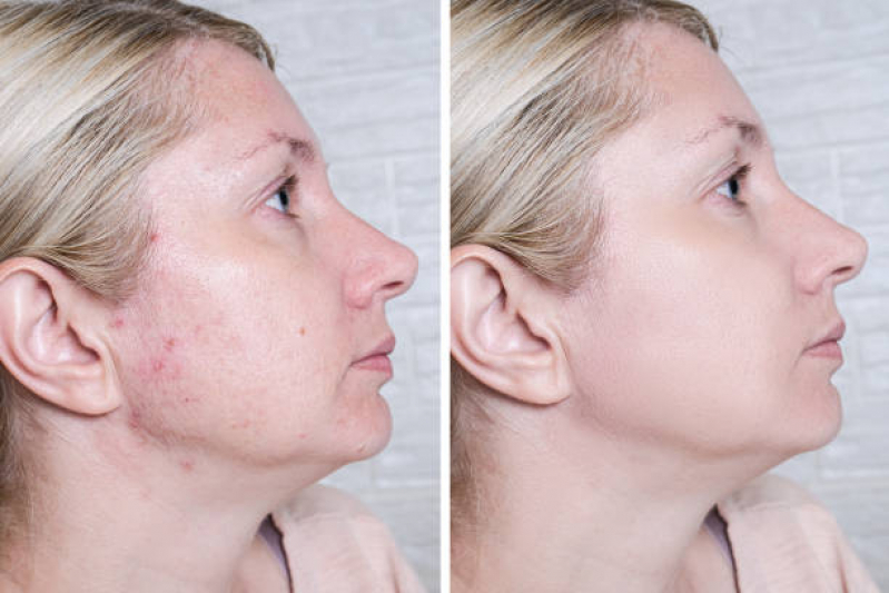 Limpeza de Pele Profunda Praça Da Árvore - Limpeza de Pele para Cicatrizes de Acne