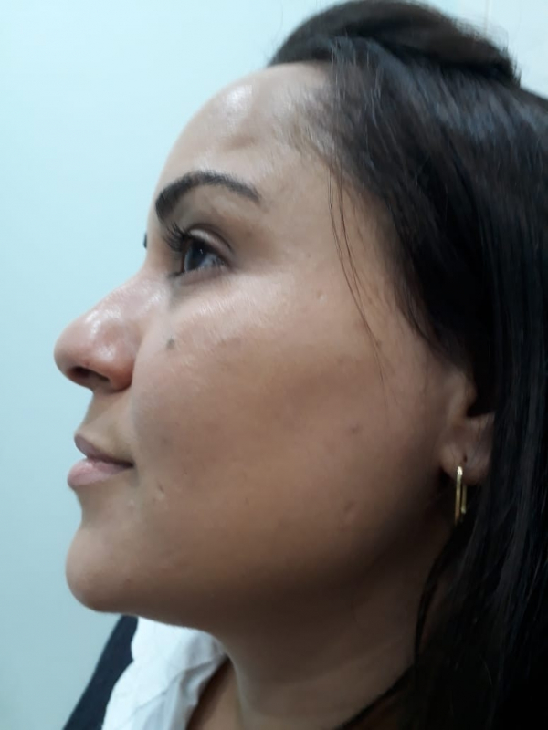 Limpezas de Pele para Tirar Cravos Vila Mariana - Limpeza de Pele com Extração