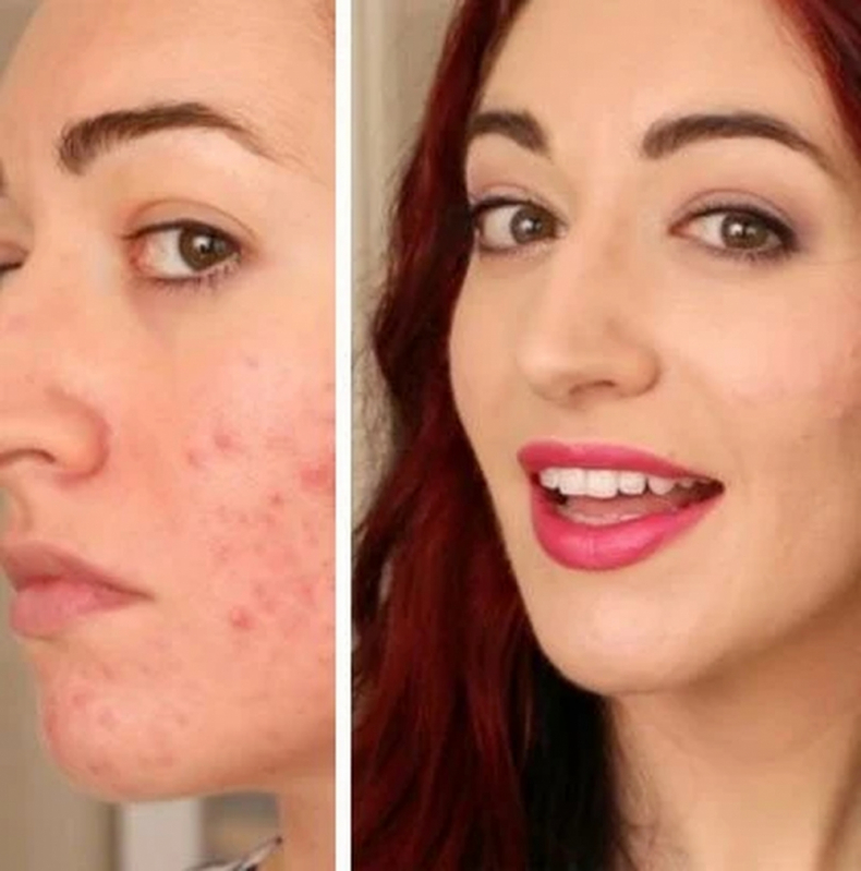 Onde Encontrar Limpeza de Pele Acne Consolação - Limpeza de Pele a Laser