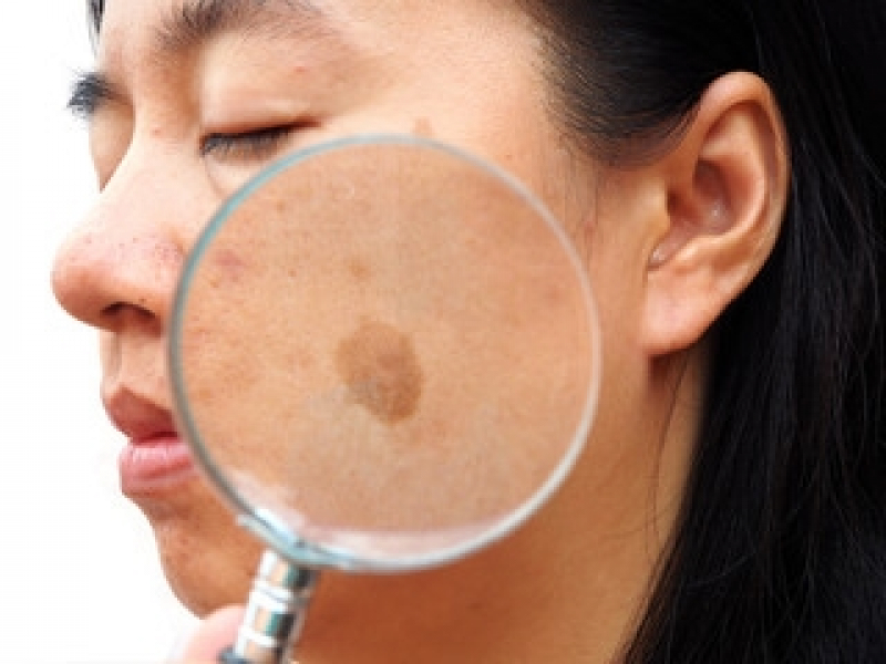 Onde Encontrar Limpeza de Pele para Tirar Manchas Bela Cintra - Limpeza de Pele a Laser