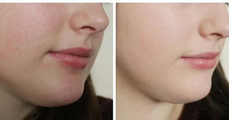 Onde Encontro Clínica de Estética para Tirar Manchas da Pele Bela Cintra - Clínica de Estética Tratamento para Celulite