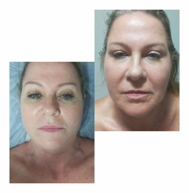 Onde Faz Rejuvenescimento Facial Natural Jardins - Rejuvenescimento para Blefaroplastia