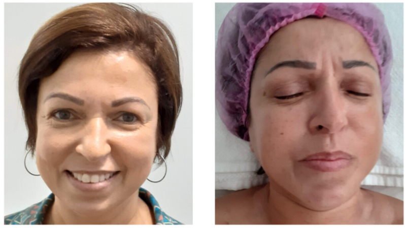 Onde Faz Rejuvenescimento Natural Facial Higienópolis - Rejuvenescimento para Olheiras