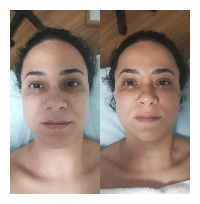 Onde Faz Rejuvenescimento para Flacidez do Rosto Chácara Klabin - Rejuvenescimento Facial Natural