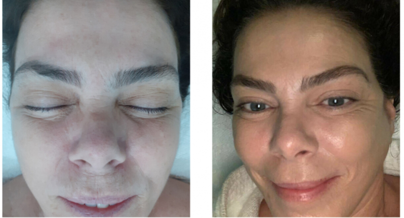 Onde Faz Rejuvenescimento para Olheiras Bela Vista - Rejuvenescimento Natural Rosto