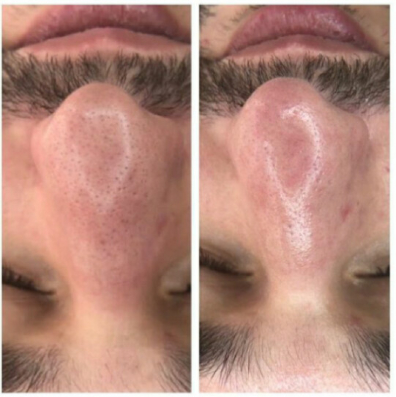 Onde Fazer Limpeza de Pele com Acne Bela Cintra - Limpeza de Pele Costas