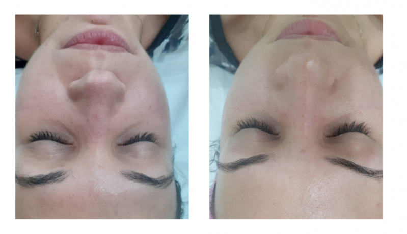 Onde Fazer Limpeza de Pele com Aplicação de Vitamina Bela Vista - Limpeza de Pele Facial