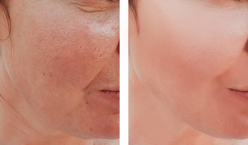 Onde Fazer Limpeza de Pele Cravos e Espinhas Chácara Klabin - Limpeza de Pele com Acne