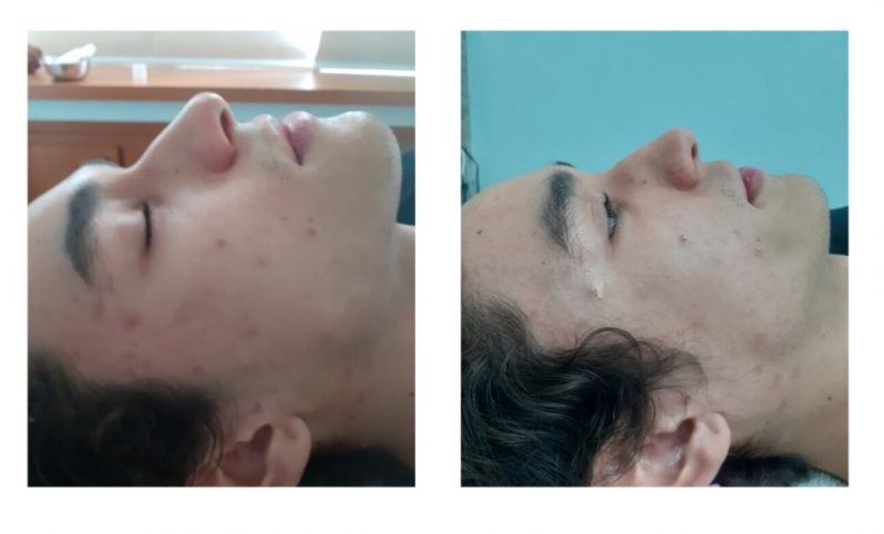 Onde Fazer Limpeza de Pele Facial Consolação - Limpeza de Pele para Cicatrizes de Acne