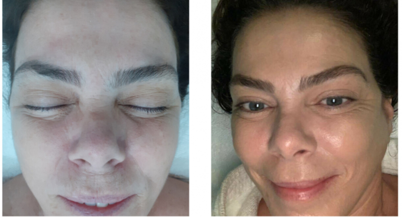 Onde Fazer Rejuvenescimento Natural Facial Bela Vista - Rejuvenescimento para Rugas na Testa